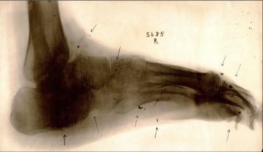 Xray of foot with foreign body